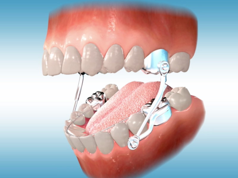 orthodontic terms and appliances
