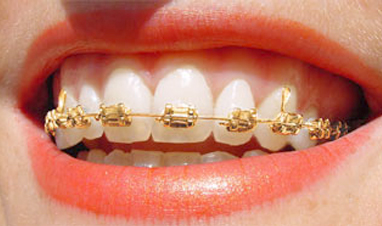 choose your braces