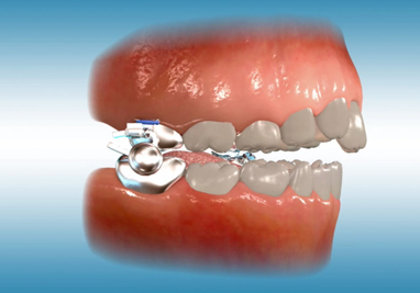 orthodontic terms and appliances