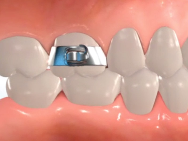 orthodontic terms and appliances