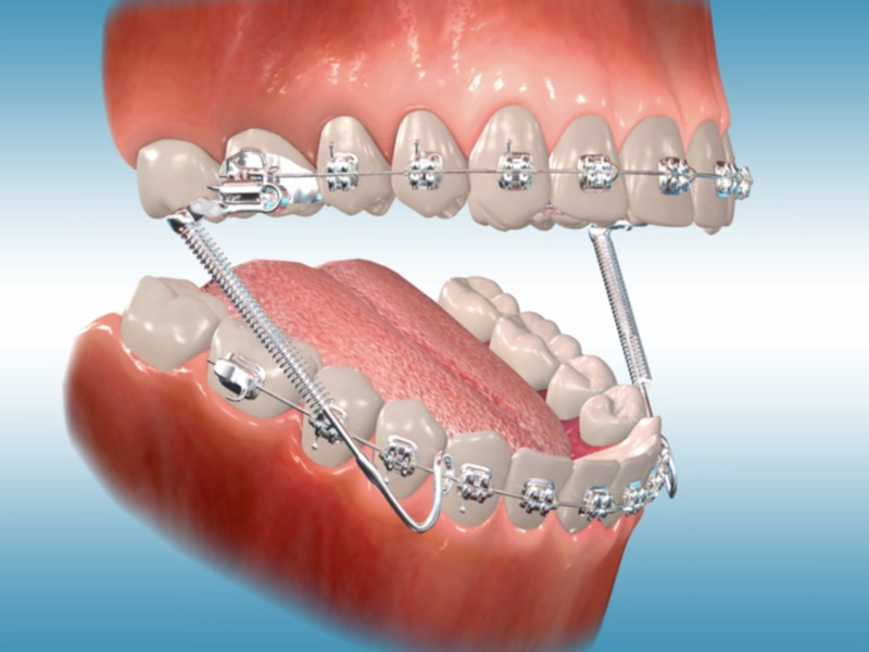 orthodontic terms and appliances