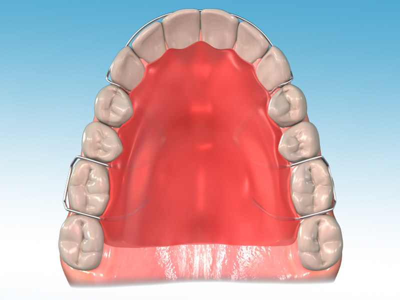 orthodontic terms and appliances