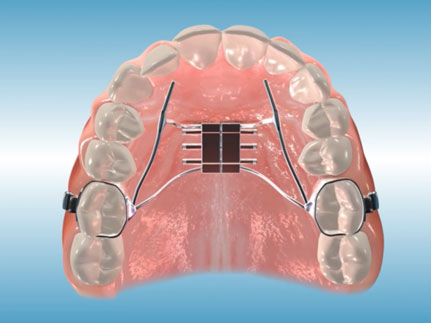 orthodontic terms and appliances