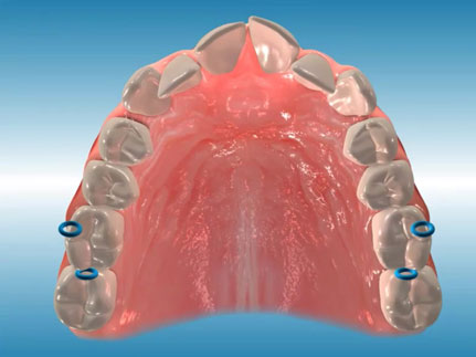 orthodontic terms and appliances