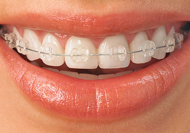 orthodontic terms and appliances