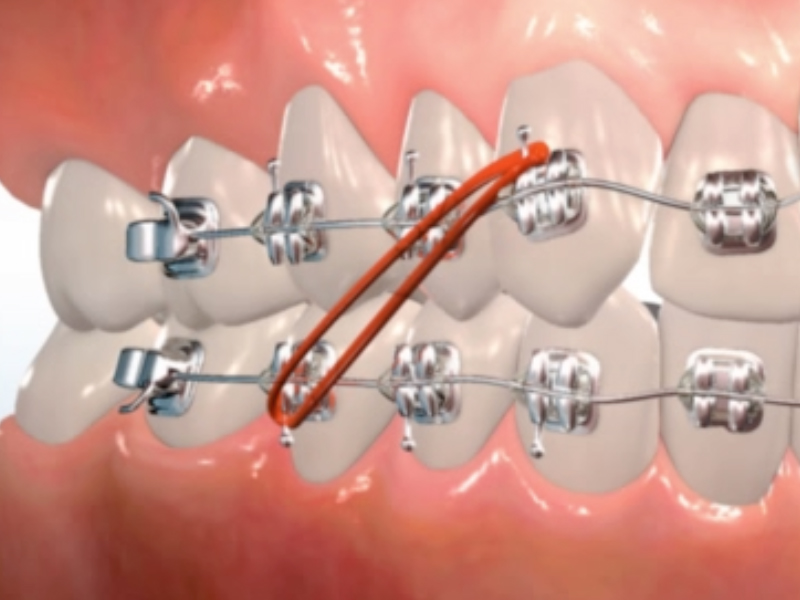 orthodontic terms and appliances