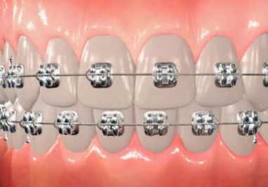 orthodontic terms and appliances