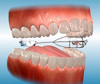 orthodontic terms and appliances