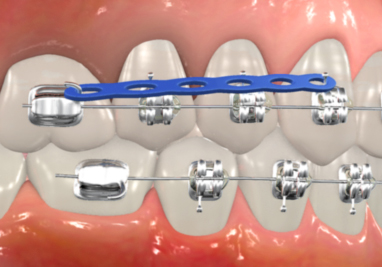 orthodontic terms and appliances