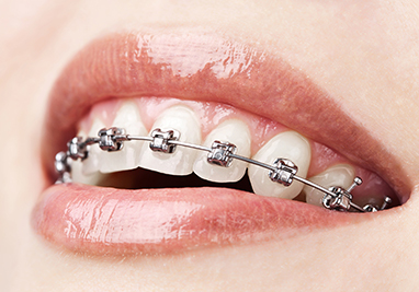 choose your braces