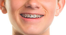 choose your braces