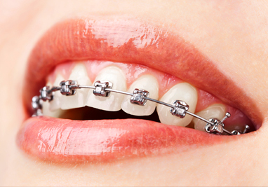 choose your braces